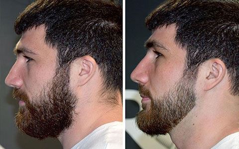 Мужской крем Razorless Shaving: до и после