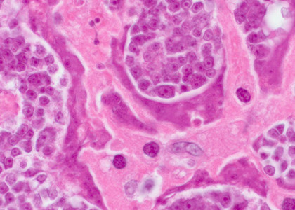 Клетки злокачественной опухоли, передавшейся человеку от червя-паразит