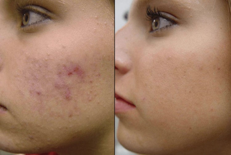 Тональный крем dermacol: фото до и после